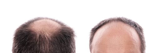 före och efter hårtransplantation